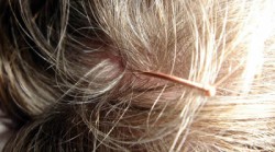 Traditionelle chinesische Medizin Akupunktur