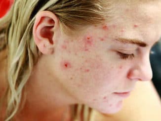 Haut-Reaktion-AusschlagNeurodermitis-struggle